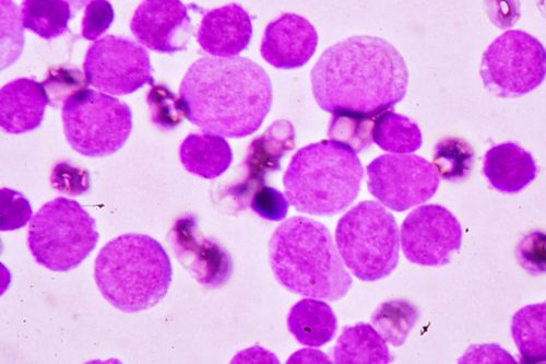 Adul Acute Myeloid Leukemia (AML) purple bubbles