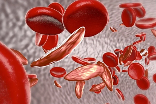 Sickle Cell Disease red blood cells particles flow