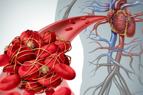 Thrombosis blood clotting's in body